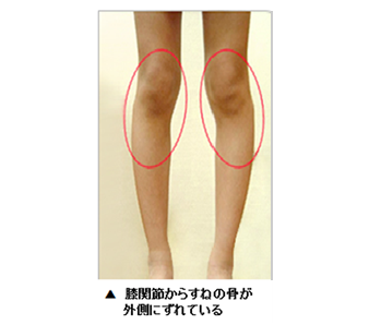 脛骨外側変位 O脚 X脚 アイレッグ Sp版