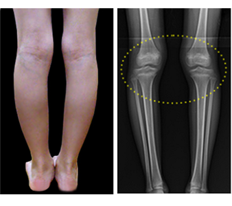 脛骨外側変位 O脚 X脚 アイレッグ Sp版